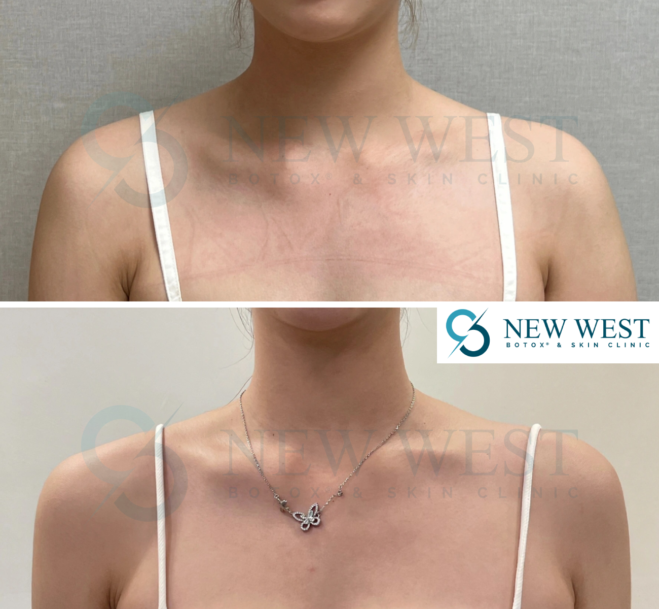 Botox Treatment - Before & After | New West Botox & Laser Skin Clinic