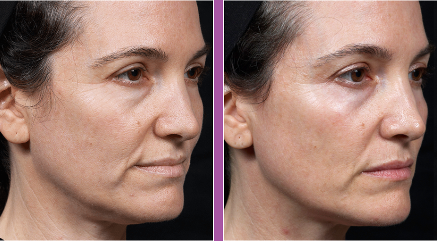 Non Surgical Facelift of lady