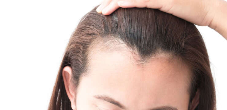 Hair Loss Clinic New Westminster | New West Botox & Skin Clinic