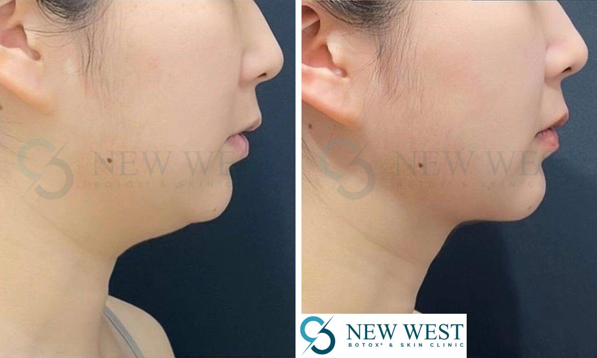 Double Chin Treatment - Before & After | New West Botox & Laser Skin Clinic